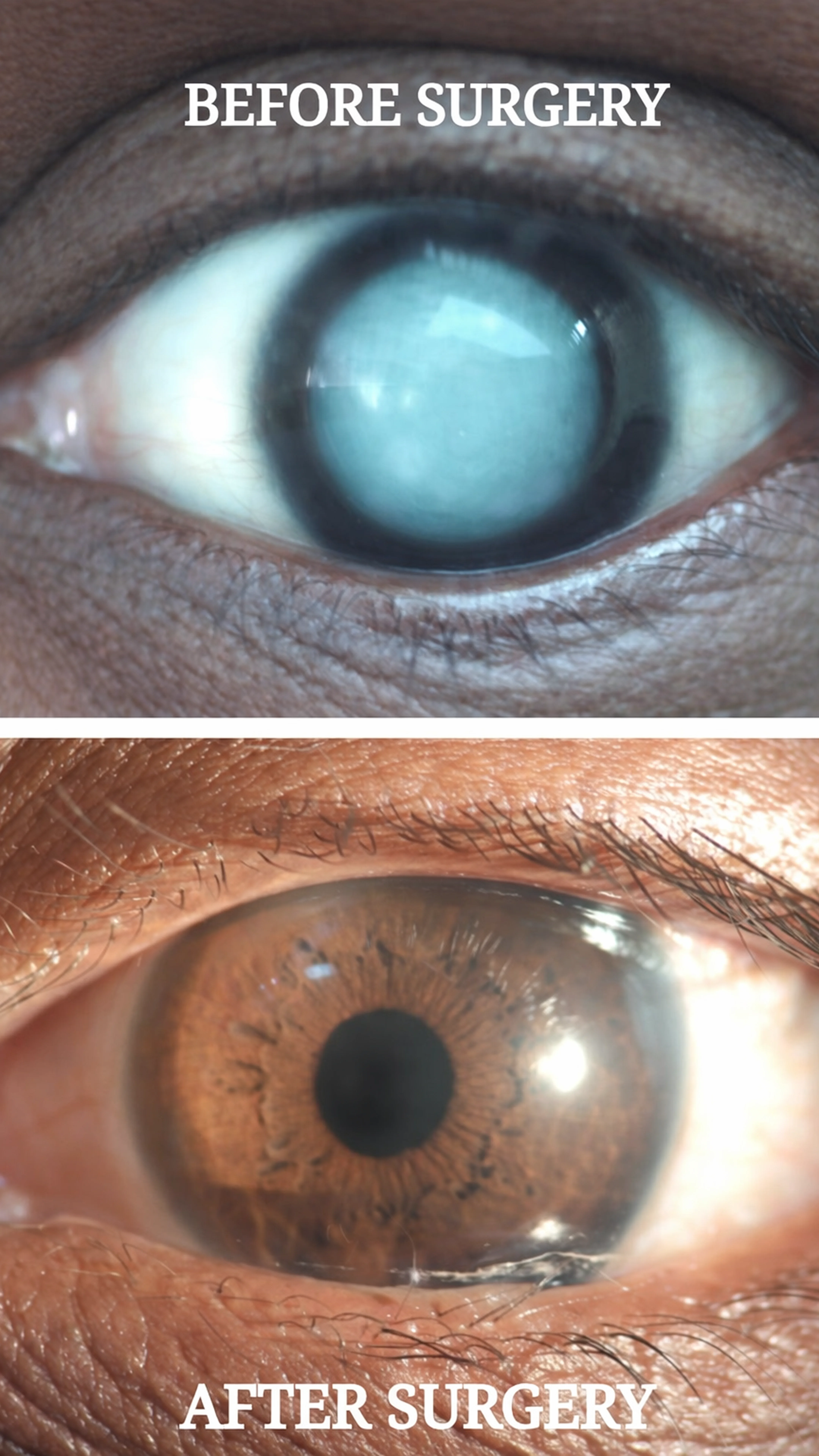 Cataract